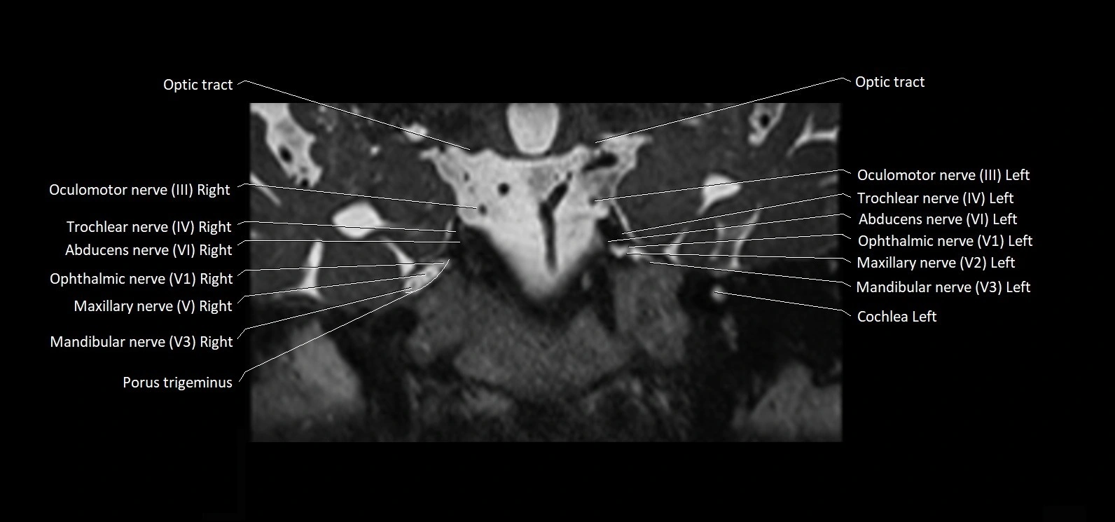 Cranial nerve cross sectional anatomy coronal 3T MRI image 34.webp